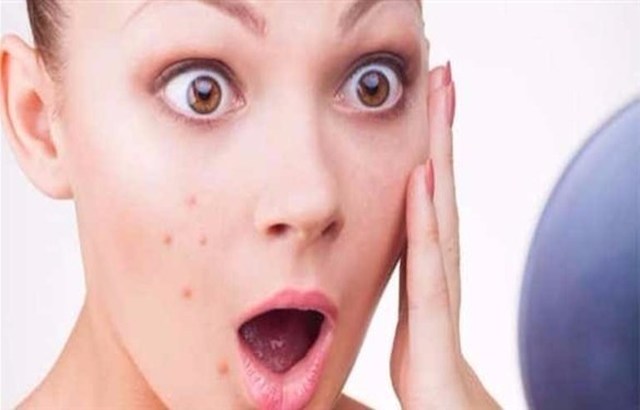 هذه الأطعمة تهدد بشرتك بالبثور