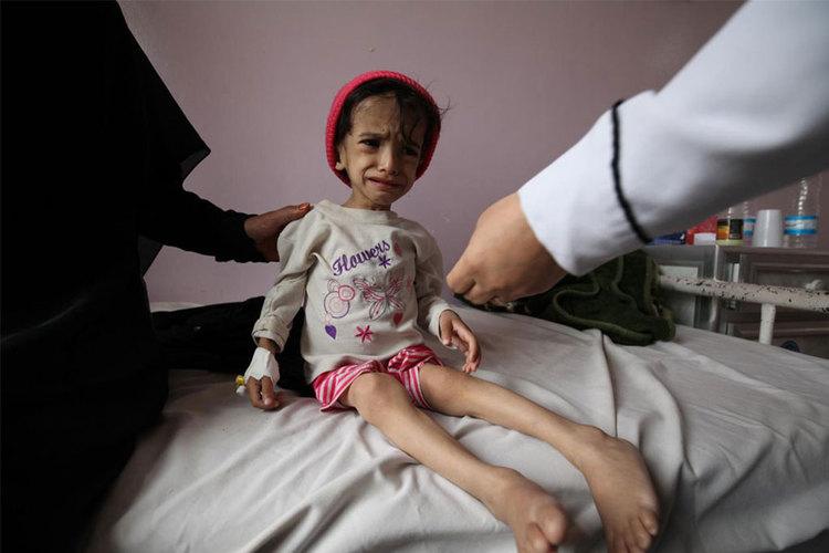الصحة العالمية: أكثر من 35 ألف طفل في اليمن يعانون من سوء التغذية