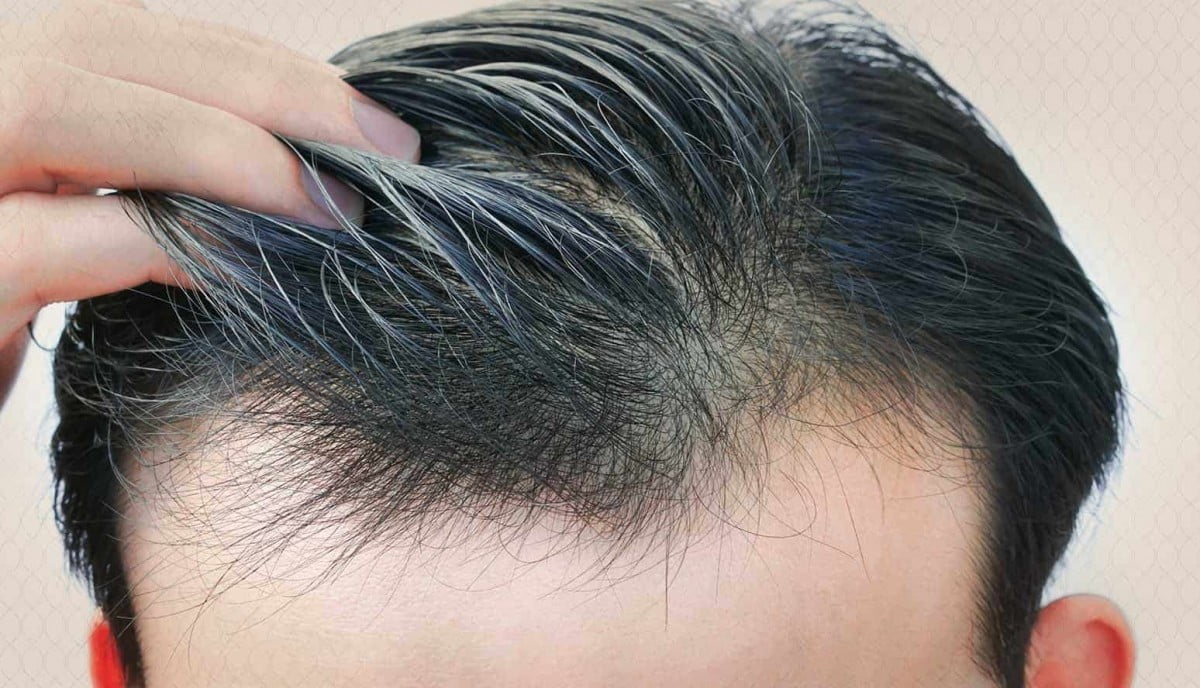 ستة عوامل تتوقف عليها زراعة الشعر .. تعرف عليها
