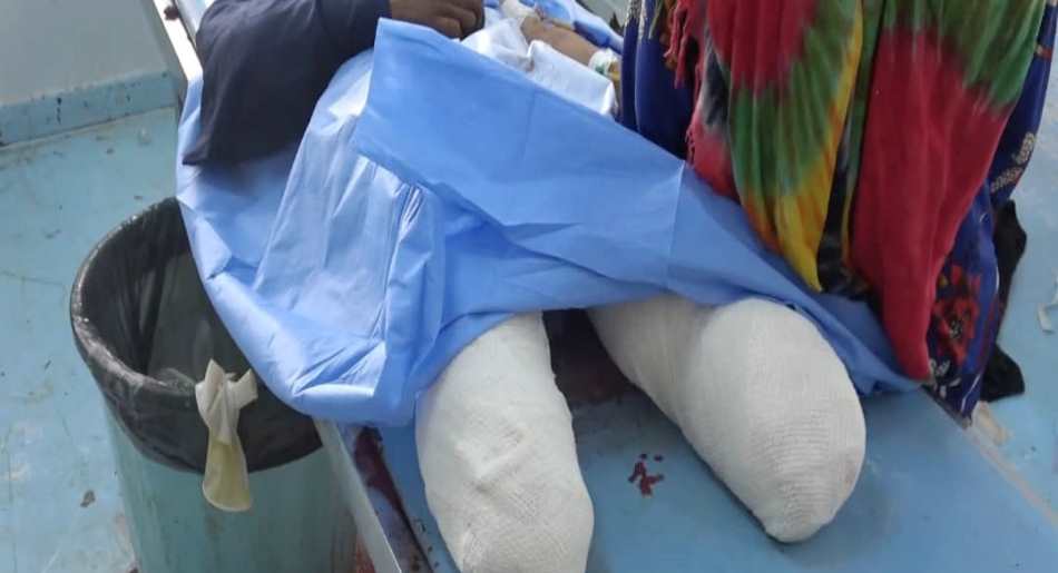 طفلة نازحة تفقد ساقيها بانفجار لغم حوثي في حيس